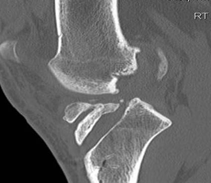 Revision ACL 4 Sagittal CT